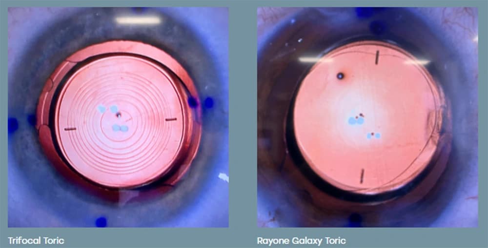 Comparação de duas lentes intraoculares implantadas no olho: à esquerda, a Trifocal Toric, com anéis concêntricos visíveis na óptica; à direita, a RayOne Galaxy Toric, com a óptica lisa, sem anéis